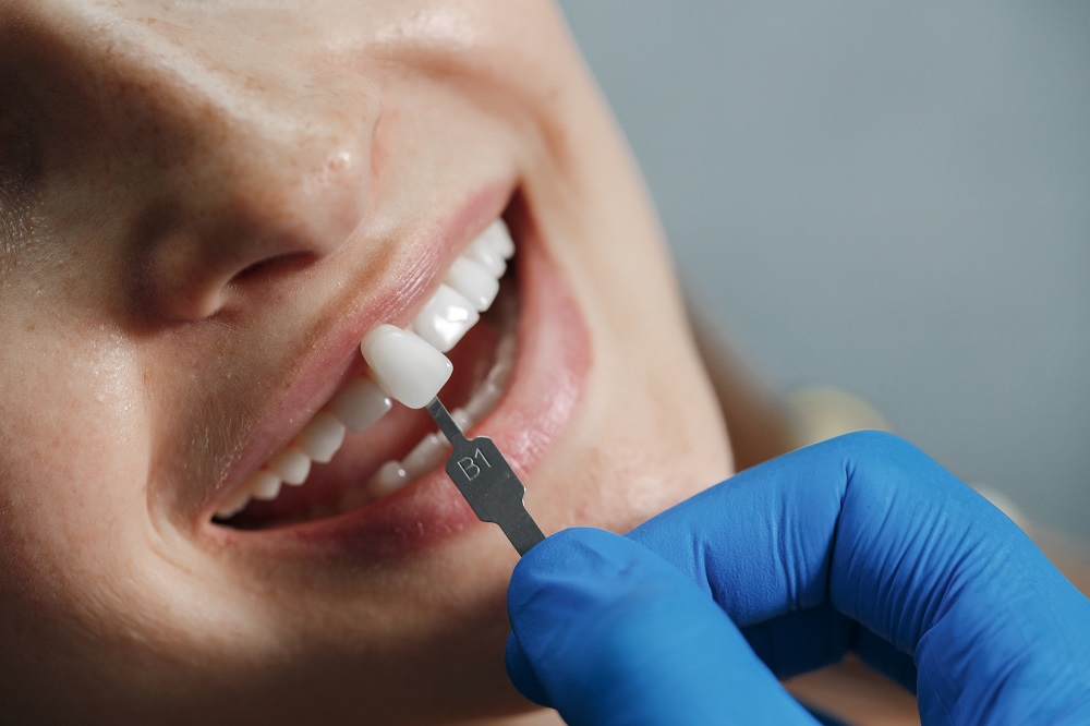 What are Dental Veneers? | Malvern Smile Studio