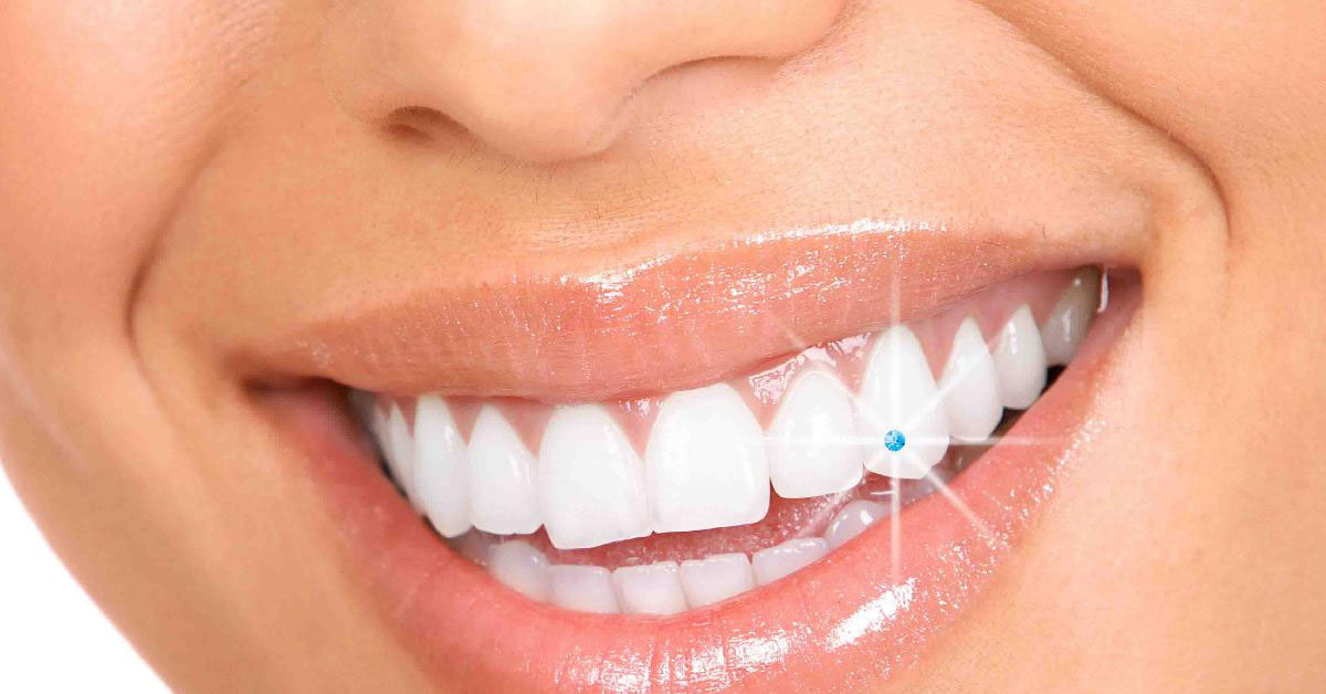 Smile Correction Treatment in Coimbatore | Smile Design