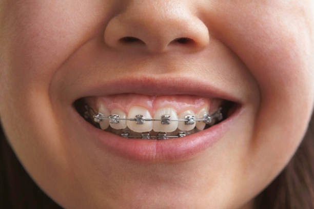 Get Your Kids to Use Braces without Any Fear