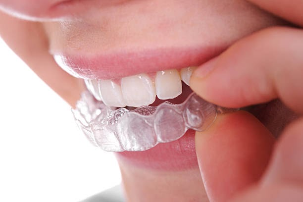 Breaking Down The Expenses Of Invisalign In 2024