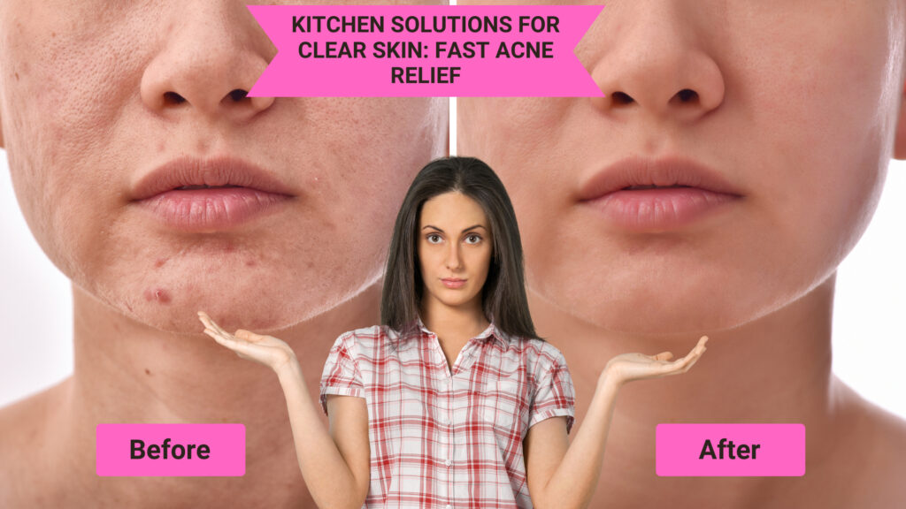 How to Use This Common Kitchen Remedies to Clear up Acne Fast