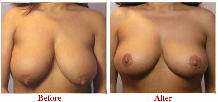 Best Breast Reduction Surgery in Delhi- Best Surgery Cost